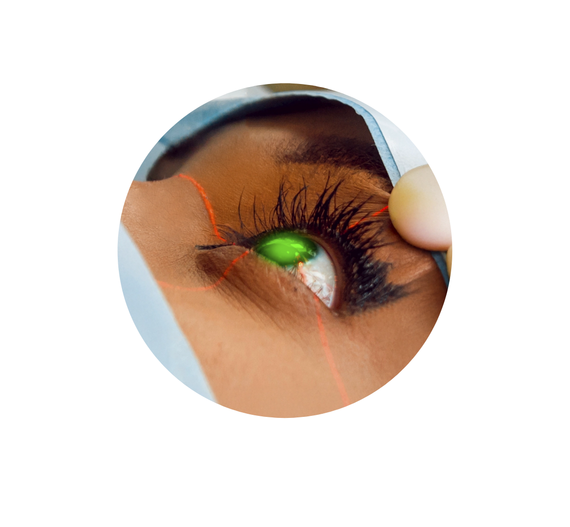 Procedimiento con láser ocular